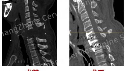 全球罕见！“身首离断”患者被救回 主刀医生：术毕两月整，已脱离呼吸机半月